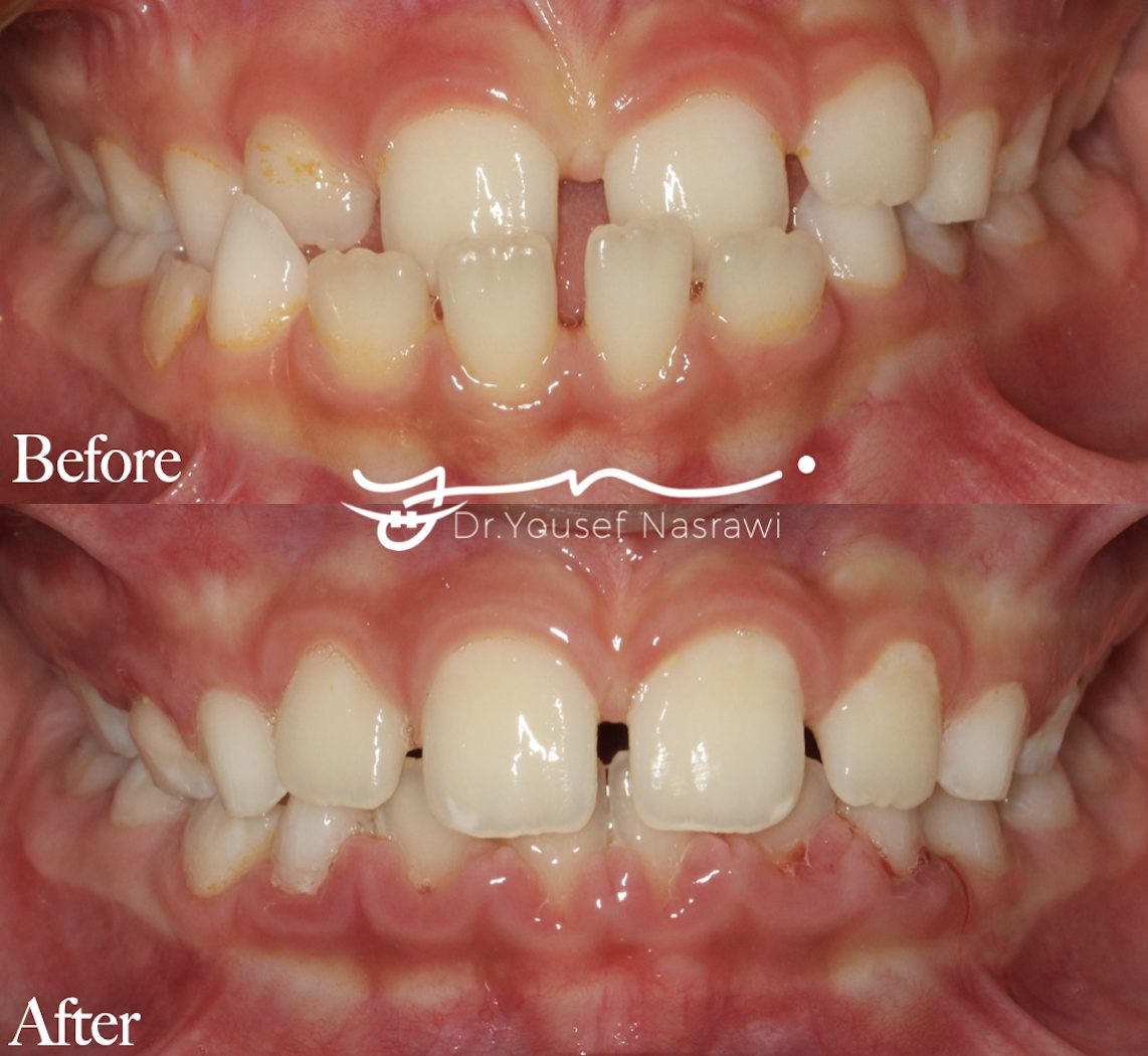 Before and after orthodontic treatment — Anterior cross bite, Rapid maxillary expansion (RME) with protraction facemask