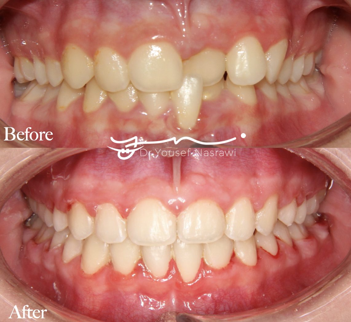 Before and after orthodontic treatment — Anterior cross bite, Fixed braces