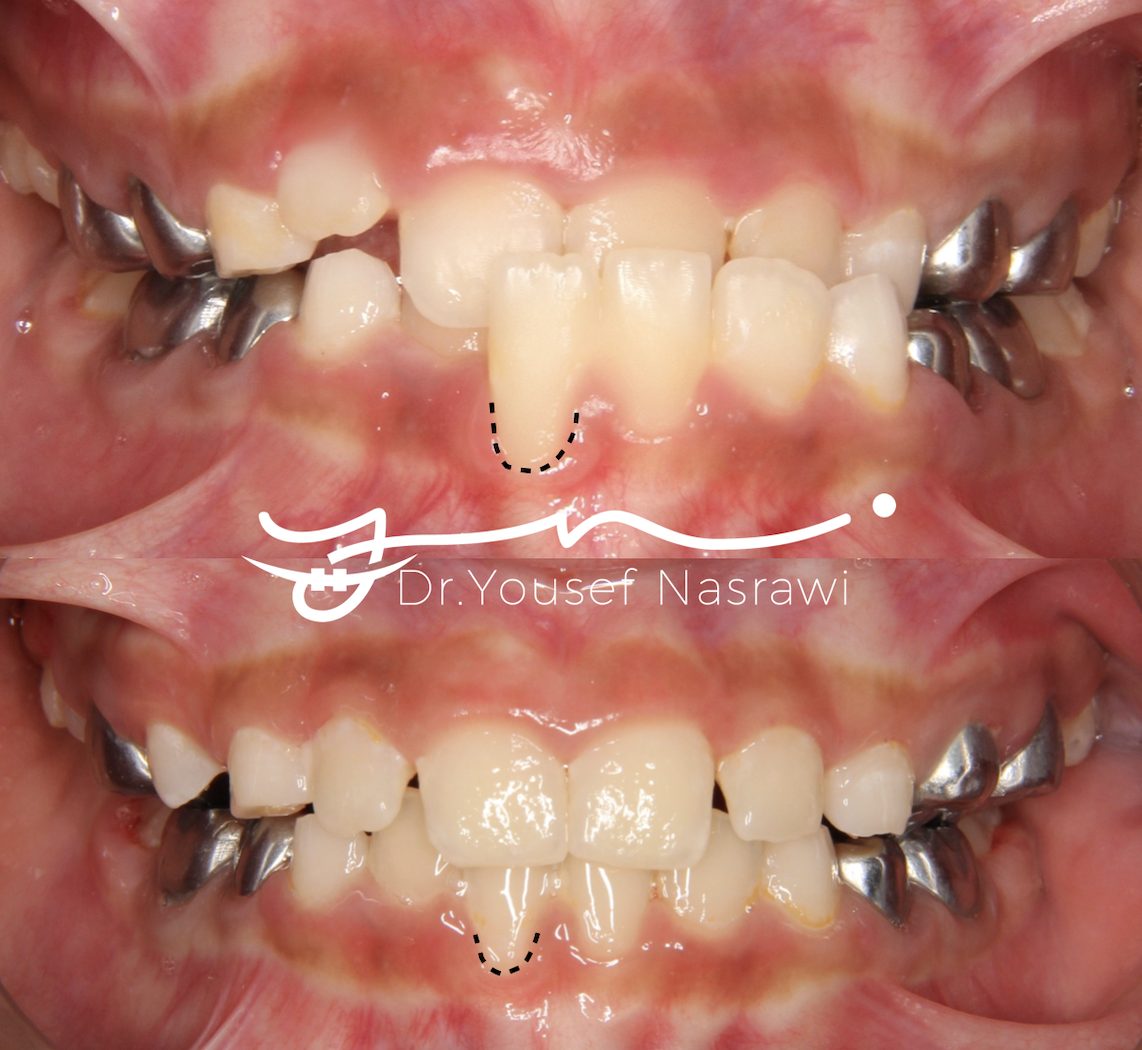 Before and after orthodontic treatment — Anterior cross bite, Sectional fixed braces