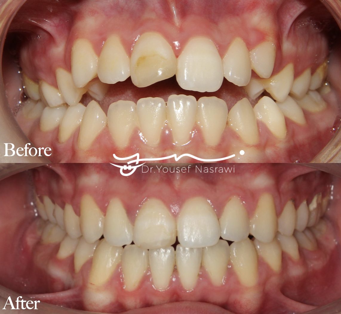 Before and after orthodontic treatment — Anterior open bite case with full fixed + TADs, Fixed braces with temporary anchorage devices (TADs)