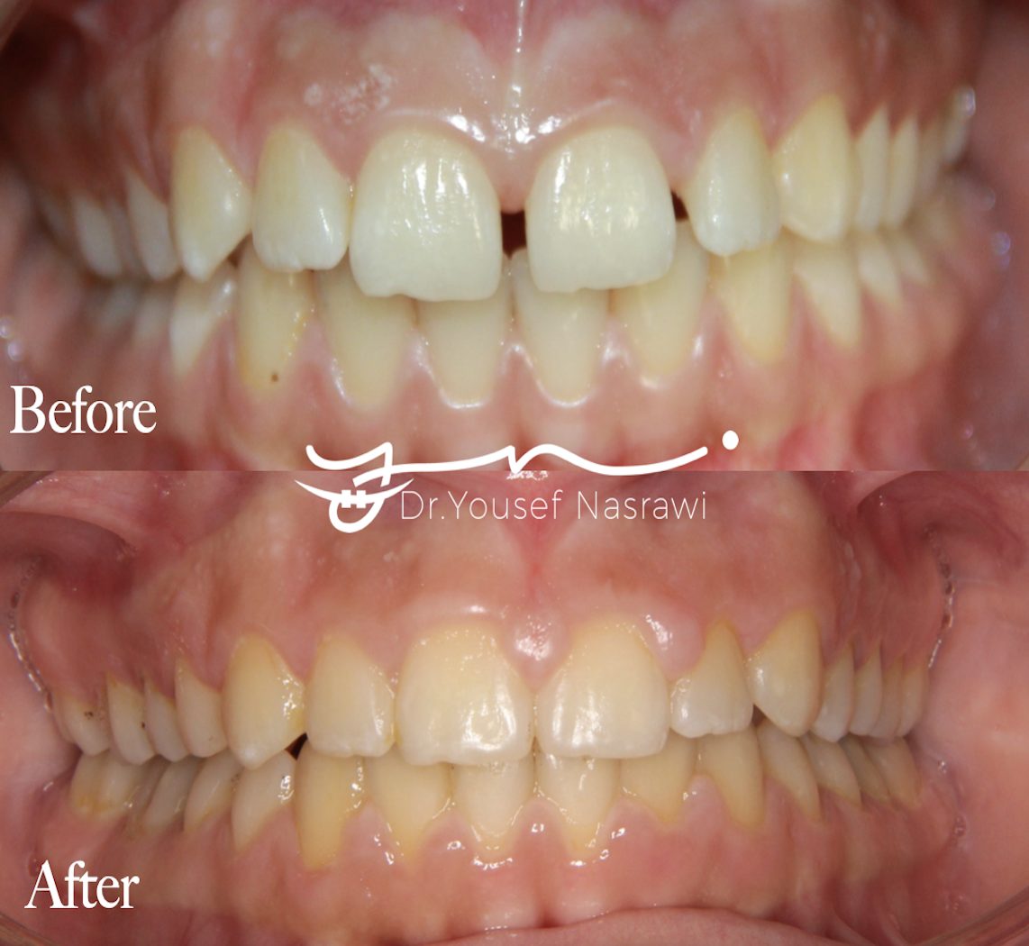 Before and after orthodontic treatment — Class 1 malocclusion with spacing, Fixed braces