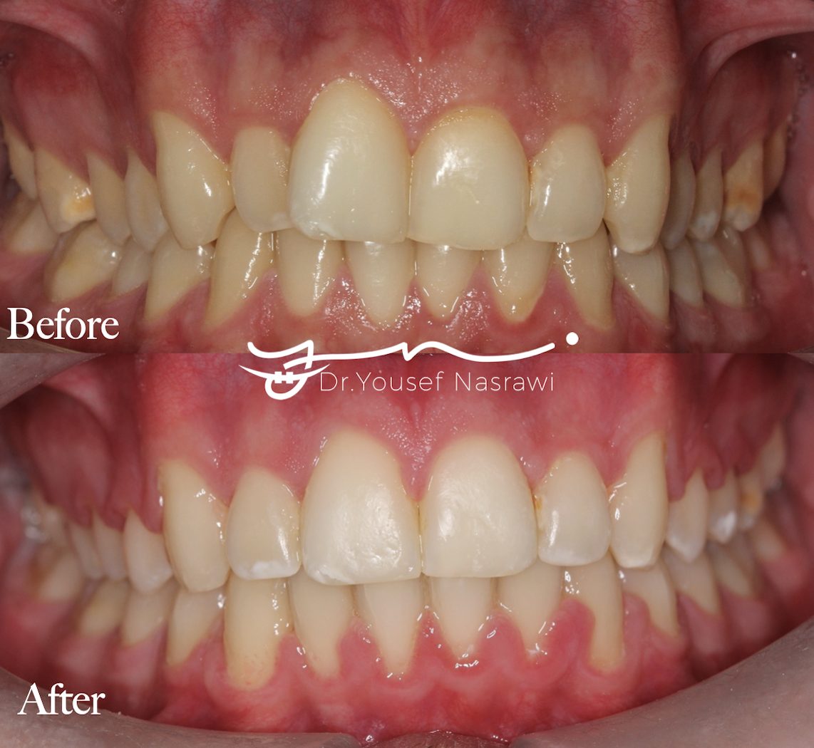 Before and after orthodontic treatment — Class 1 malocclusion, Fixed braces