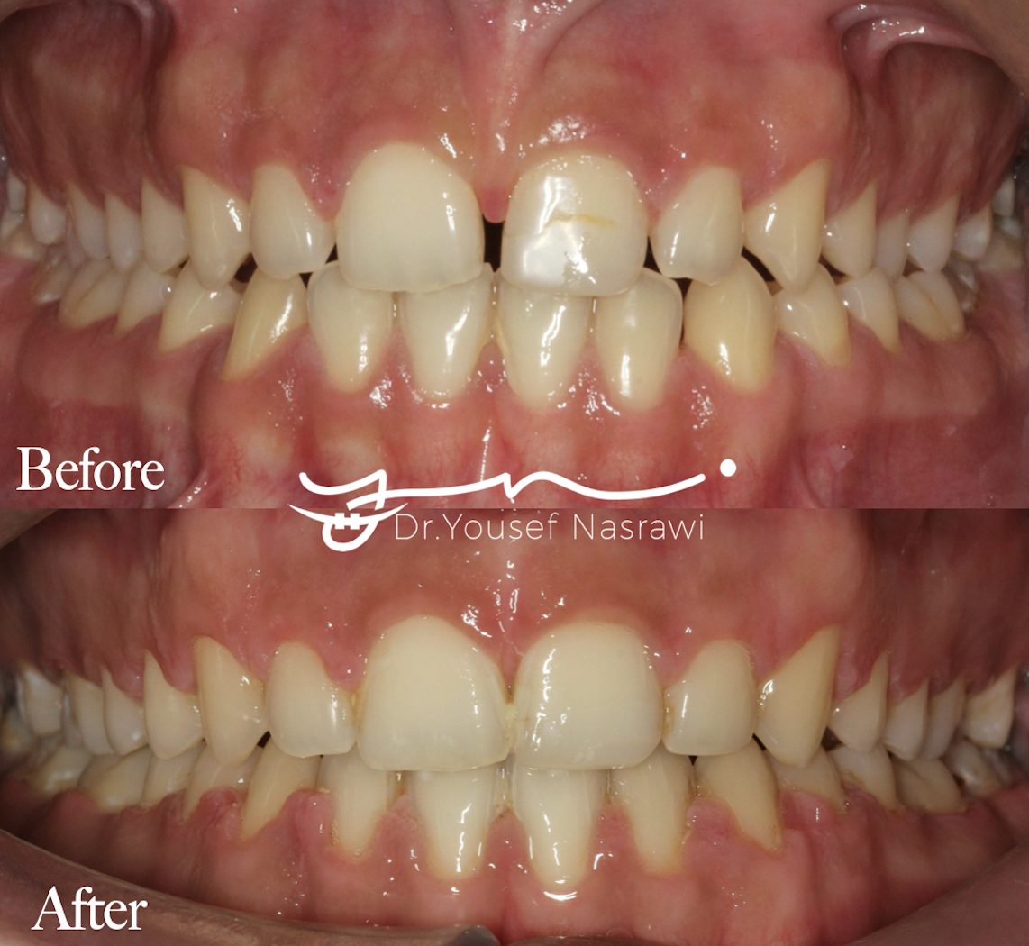 Before and after orthodontic treatment — Class 1 , spacing, Fixed braces