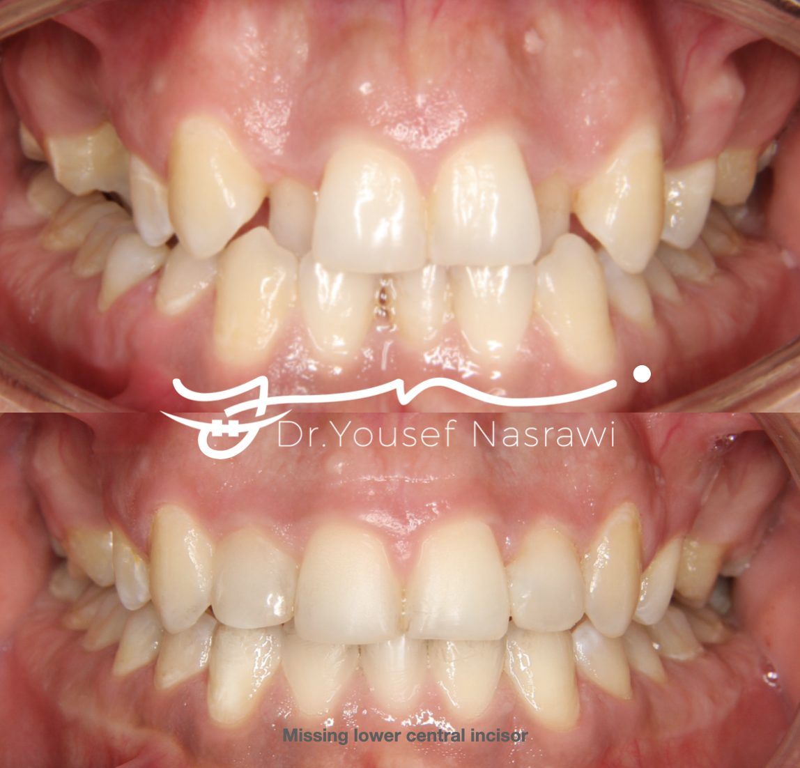 Before and after orthodontic treatment — Class 2 , anterior crossbite with spacing, Fixed braces