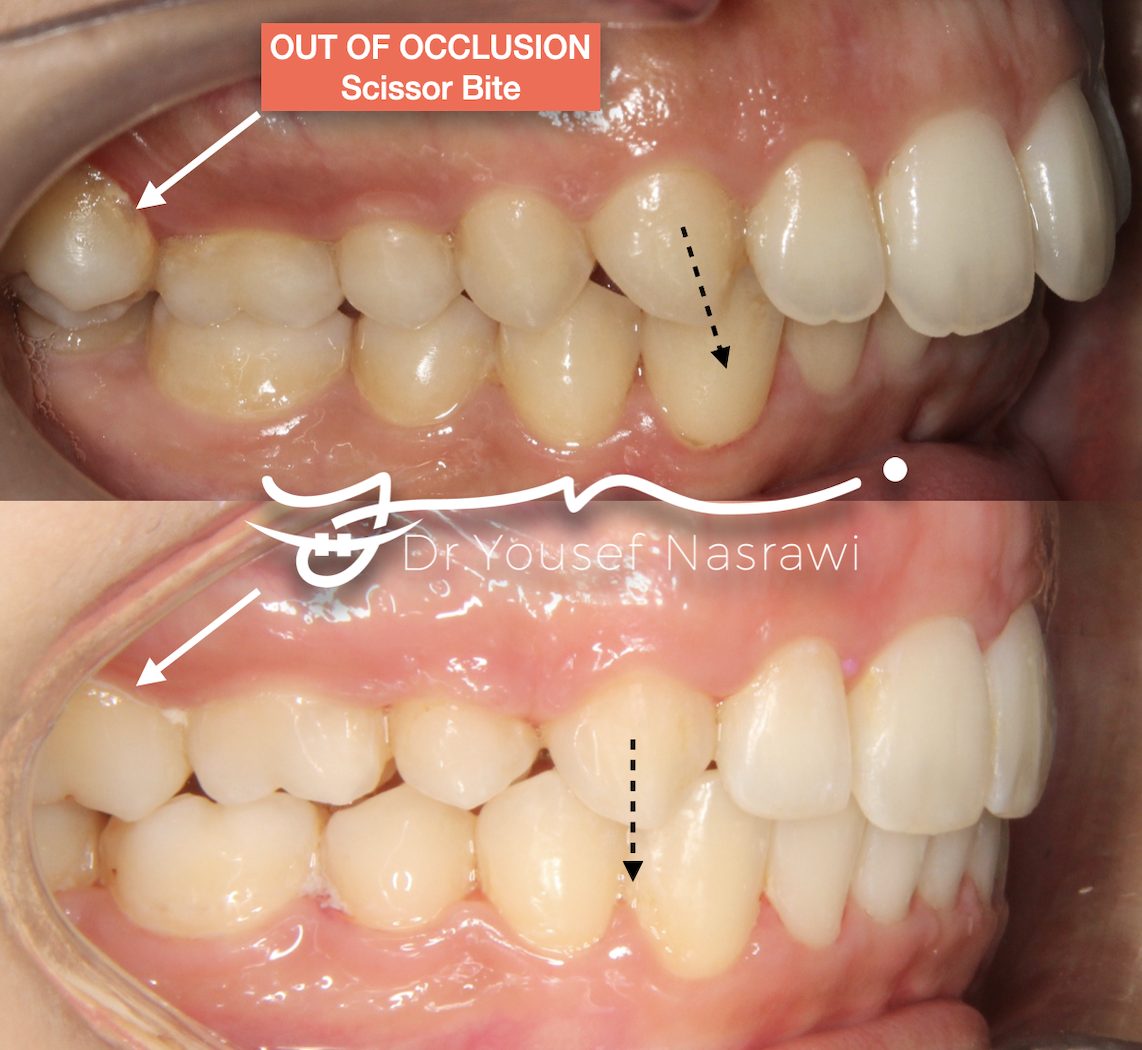 Before and after orthodontic treatment — Class 2 , extraction with scissor bite, Fixed braces