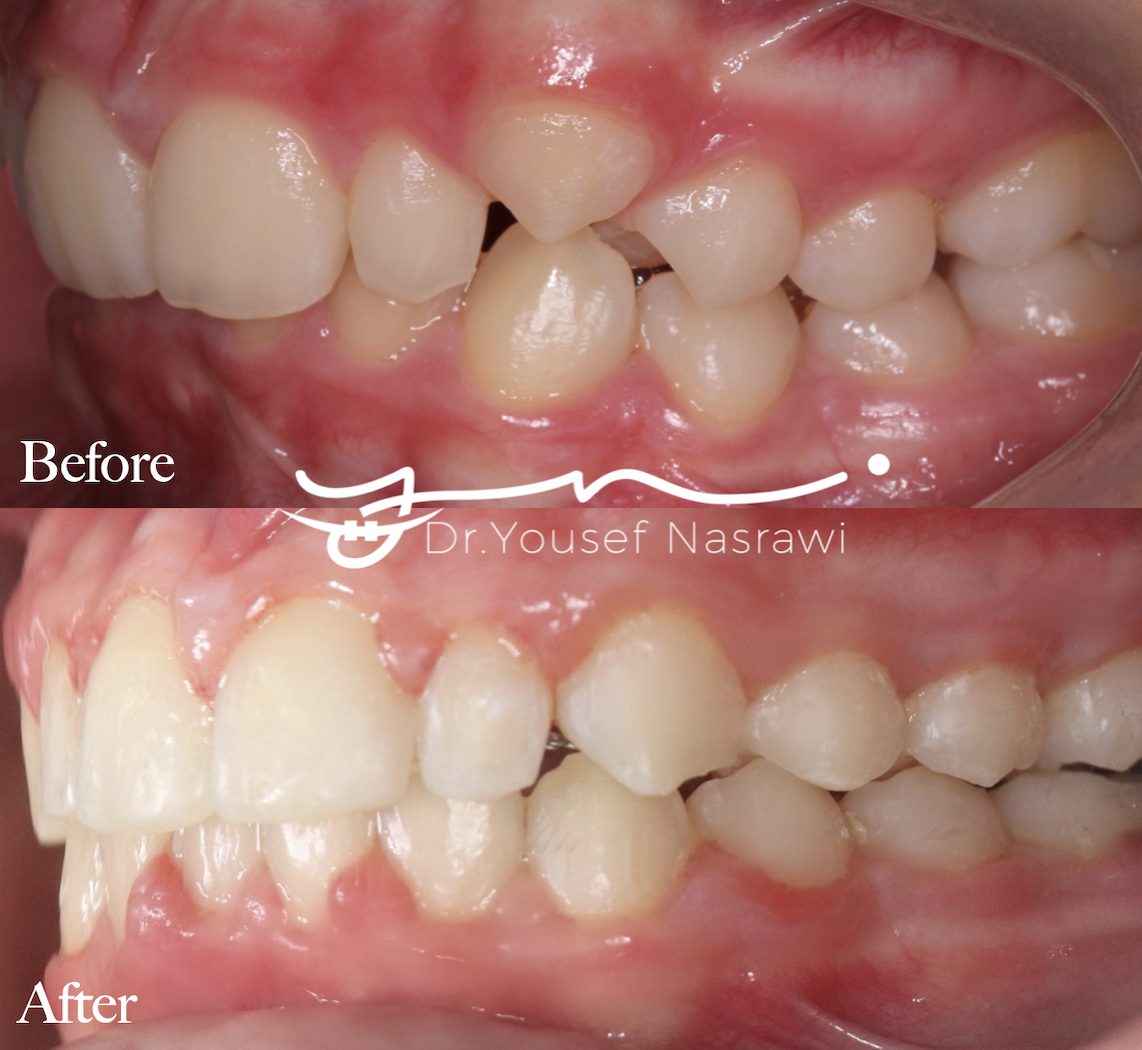 Before and after orthodontic treatment — Class 2 , high positioned canine, Fixed braces