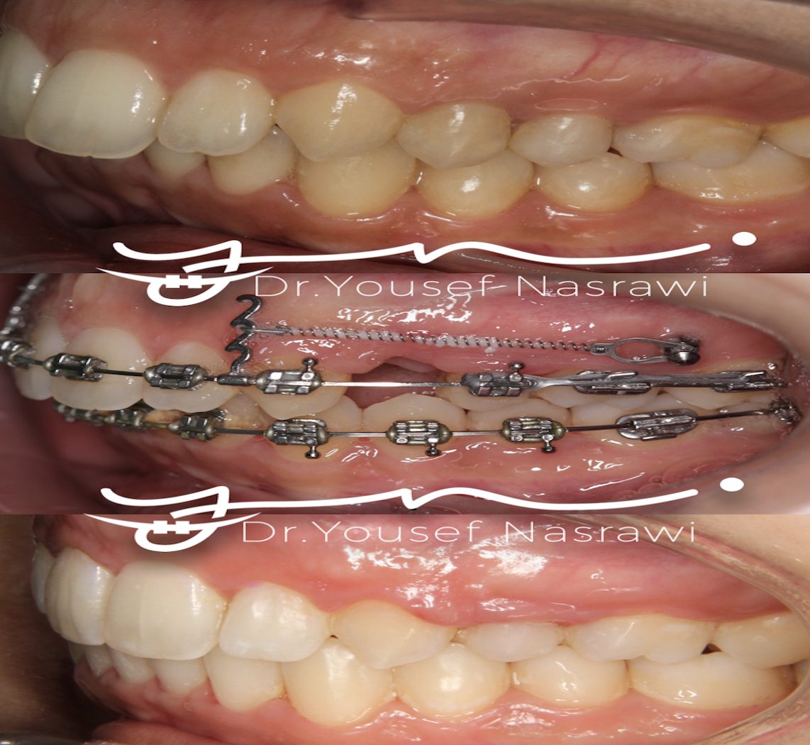 Before and after orthodontic treatment — Class 2 , increased overjet with extractions + TADs, Fixed braces with temporary anchorage devices (TADs)