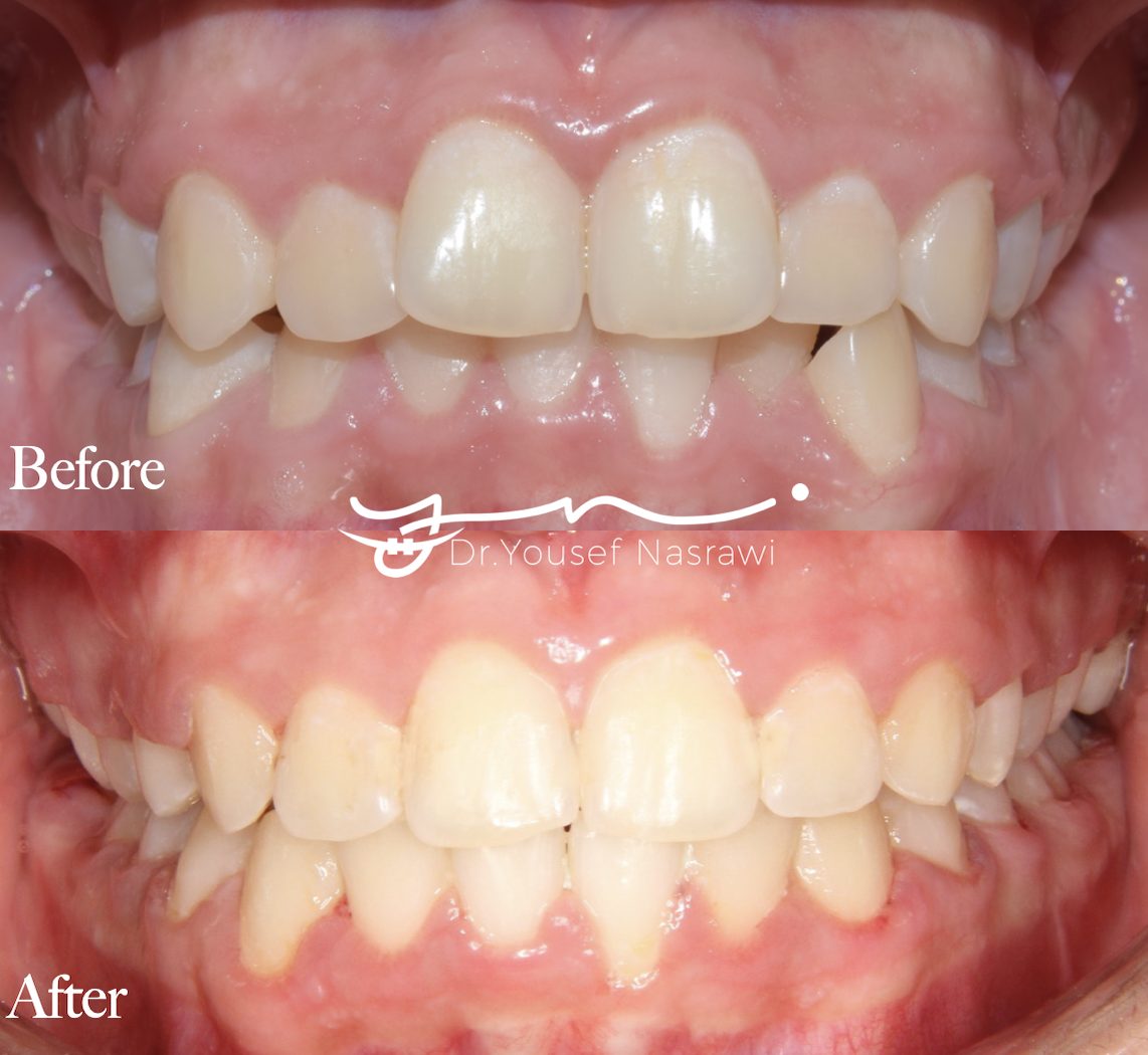 Before and after orthodontic treatment — Class 2 malocclusion, Fixed braces