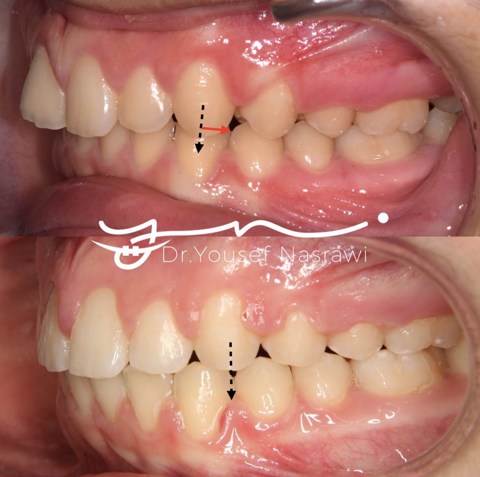 Before and after orthodontic treatment — Class 2 malocclusion with class 2 canine, Fixed braces