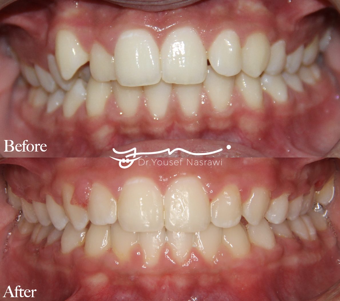 Before and after orthodontic treatment — Class 2 malocclusion with crowding, Fixed braces