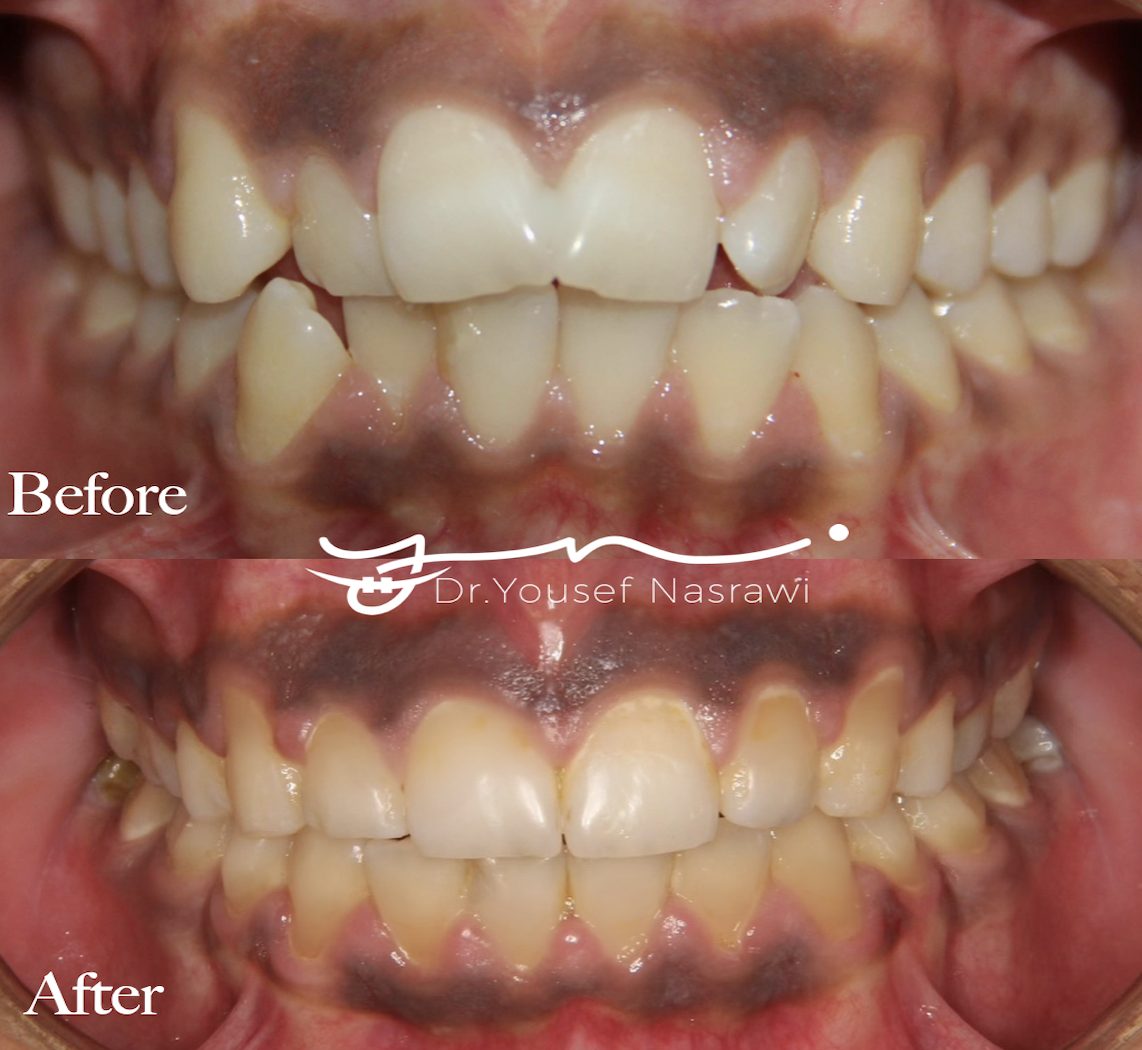 Before and after orthodontic treatment — Class 2 malocclusion with extraction, Fixed braces