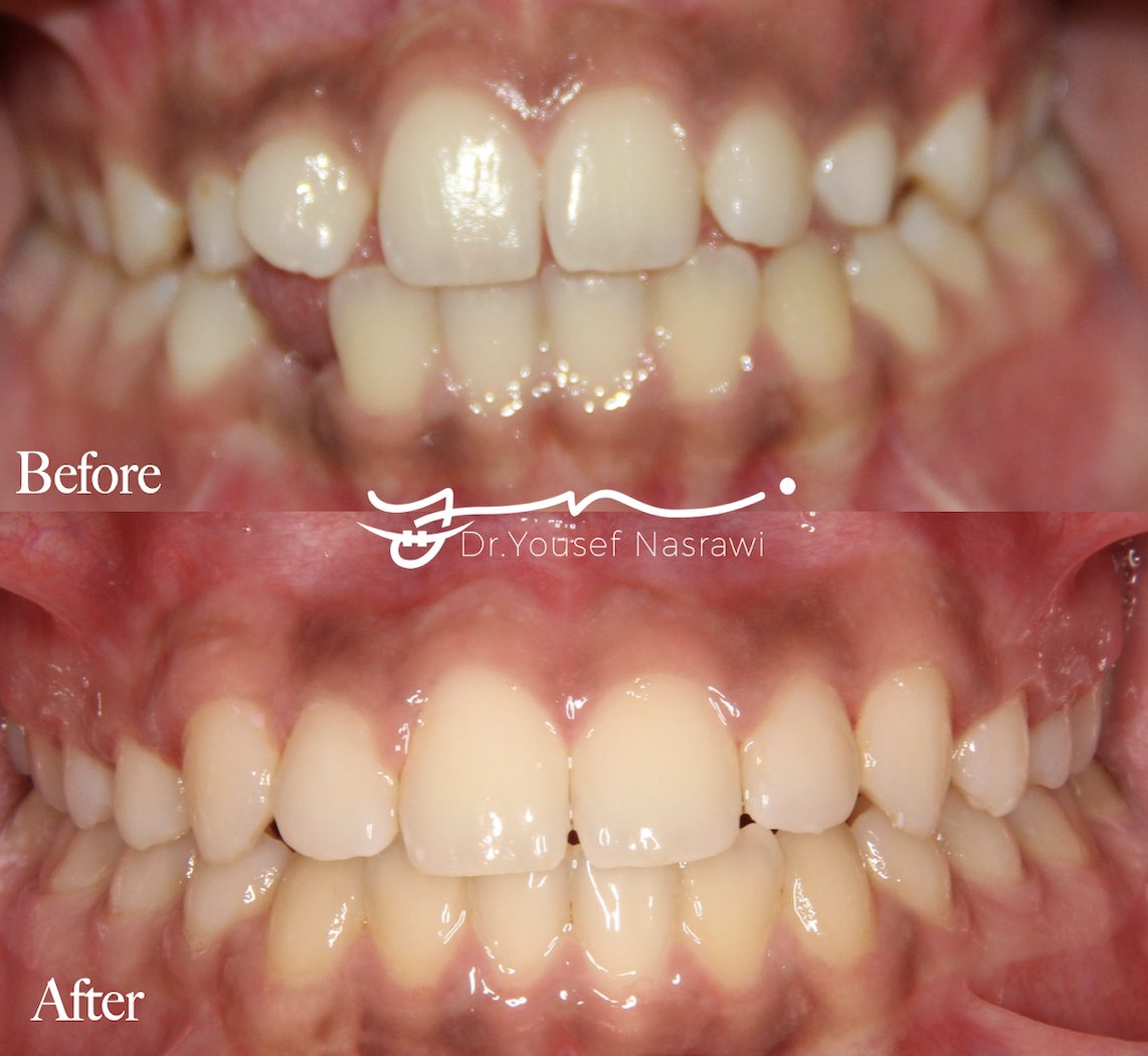 Before and after orthodontic treatment — Class 2 malocclusion with impacted canines, Fixed braces