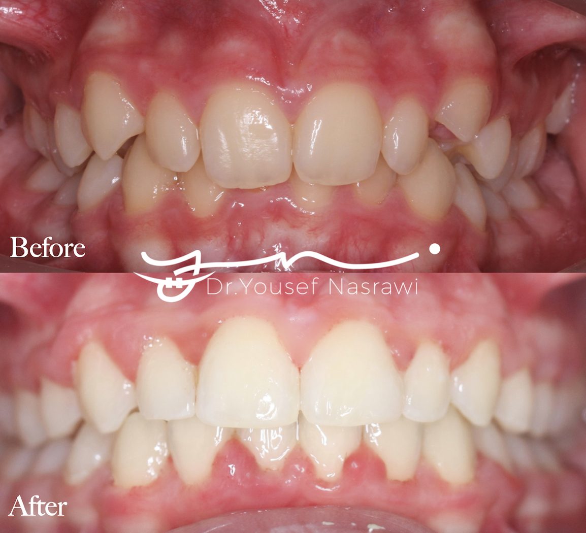 Before and after orthodontic treatment — Class 2 malocclusion, Fixed braces