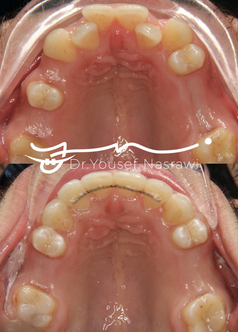 Before and after orthodontic treatment — Class 2 , old extractions sites with spacing and tucked laterals, Fixed braces
