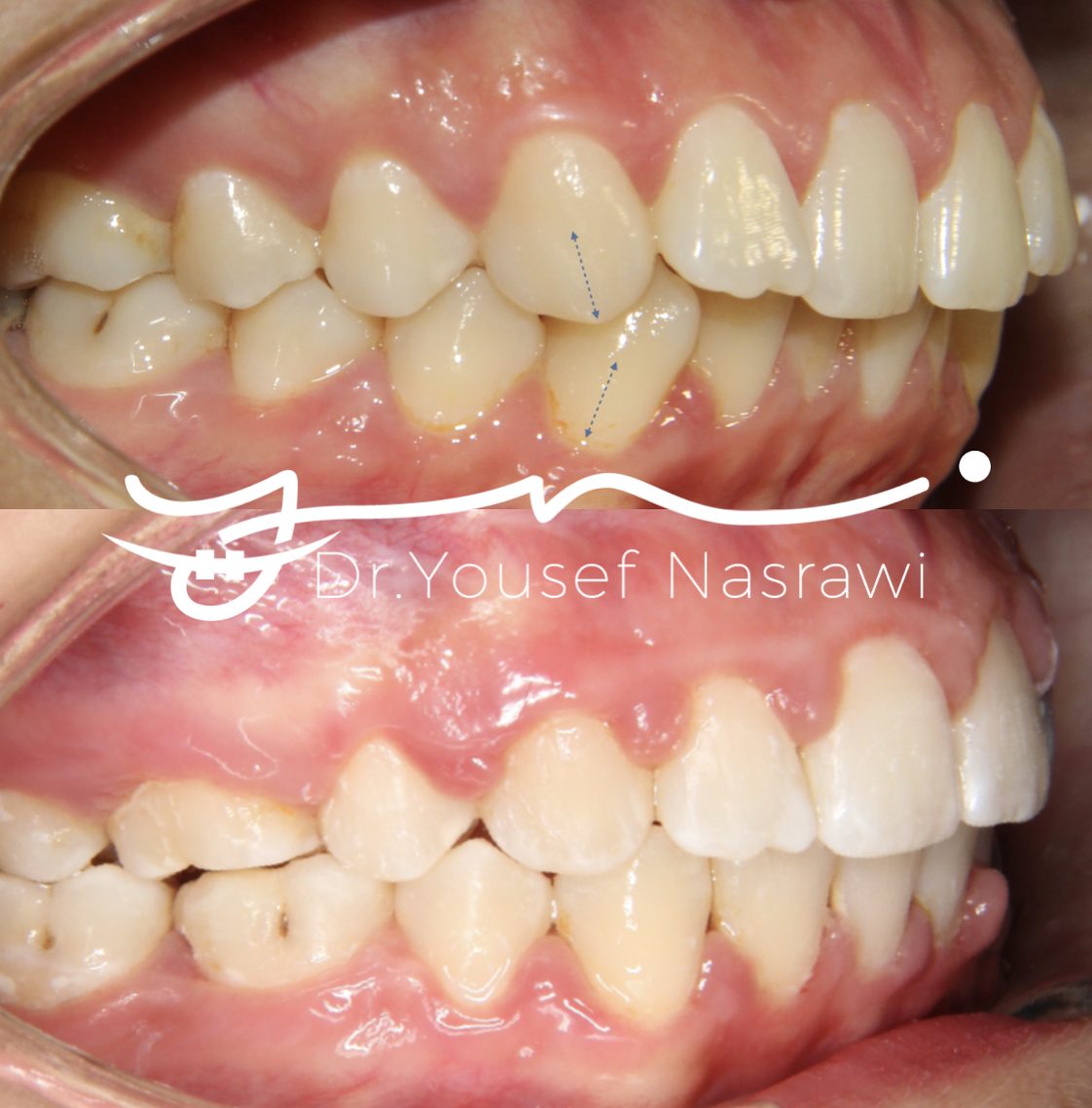 Before and after orthodontic treatment — Class 2, Fixed braces