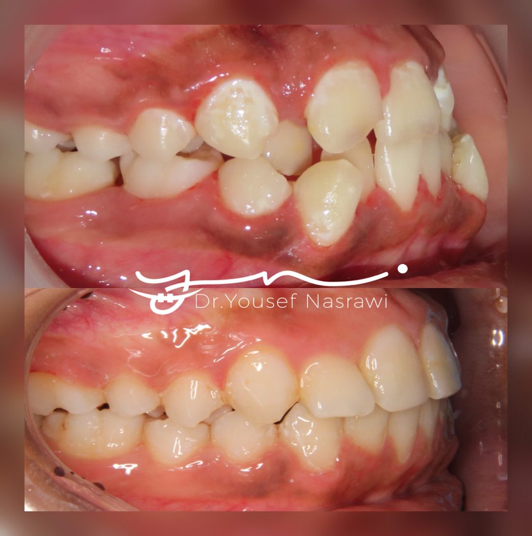 Before and after orthodontic treatment — Class 2, Fixed braces