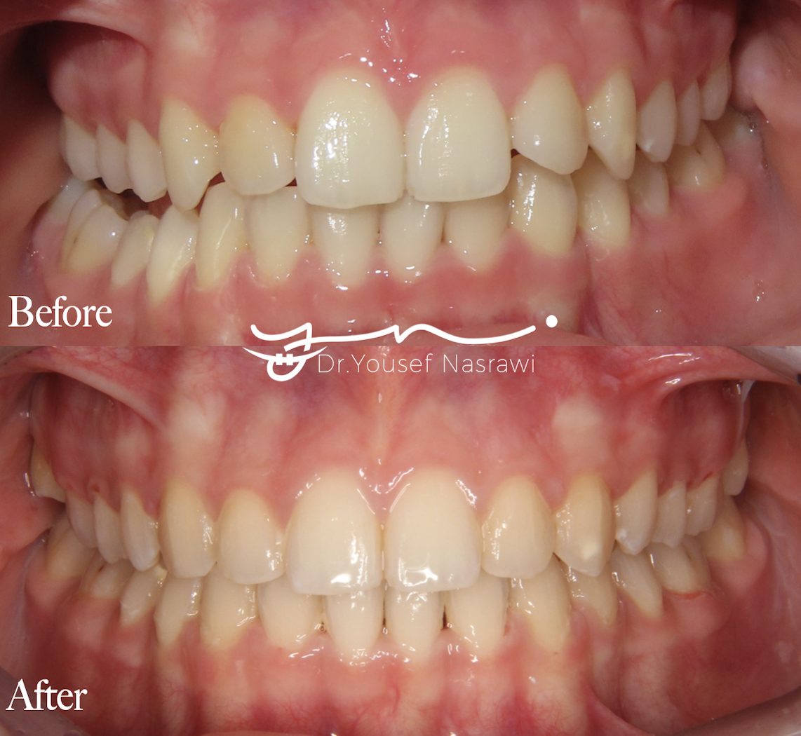 Before and after orthodontic treatment — Class 2 with dental canting, Fixed braces