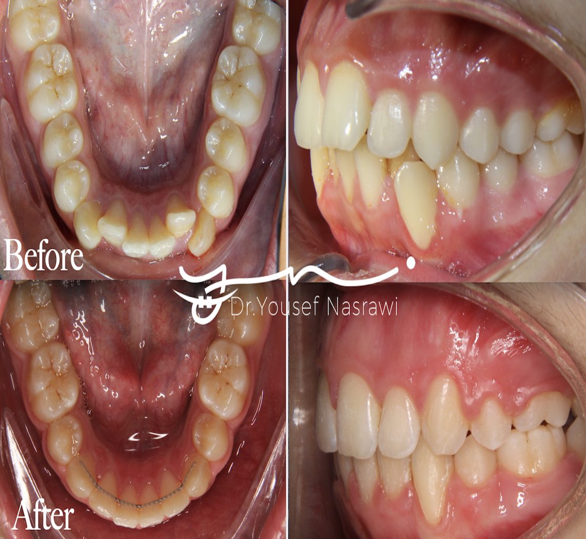 Before and after orthodontic treatment — Class 2 with extraction, Fixed braces