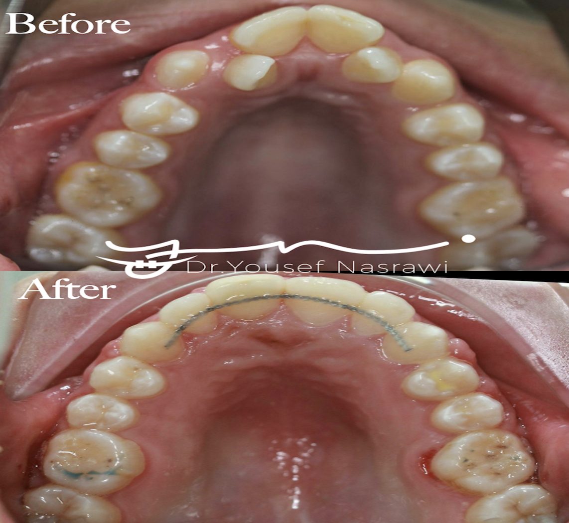 Before and after orthodontic treatment — Class 3, Fixed braces