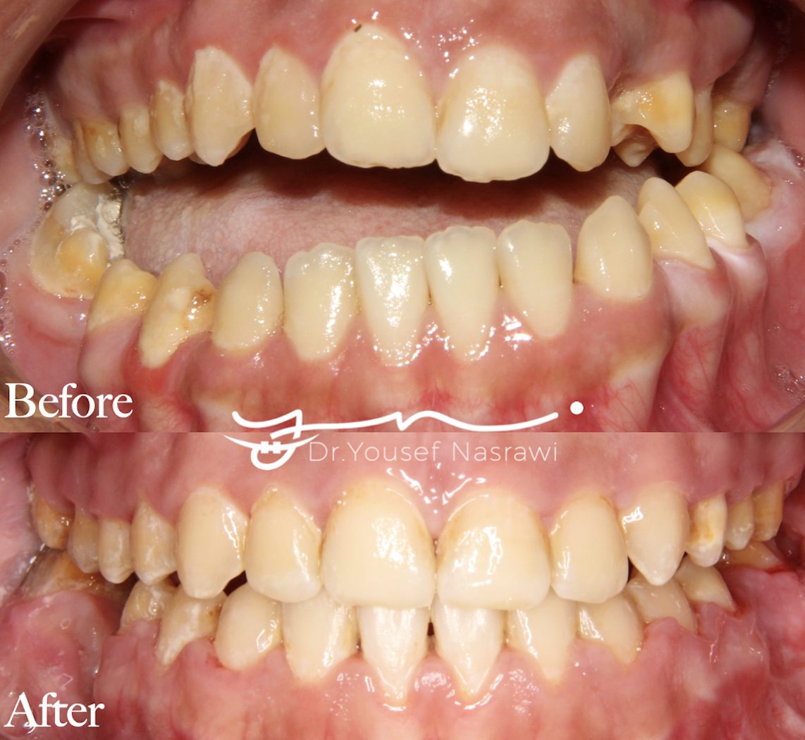 Before and after orthodontic treatment — Class 3 Orthognathic case with double canting, Presurgical orthodontics with orthognathic surgery