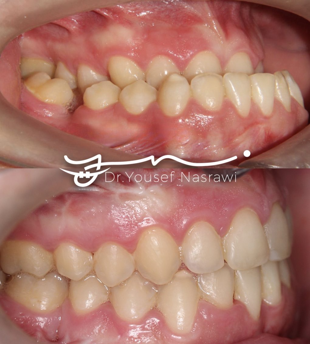 Before and after orthodontic treatment — Class 3, Presurgical orthodontics with orthognathic surgery