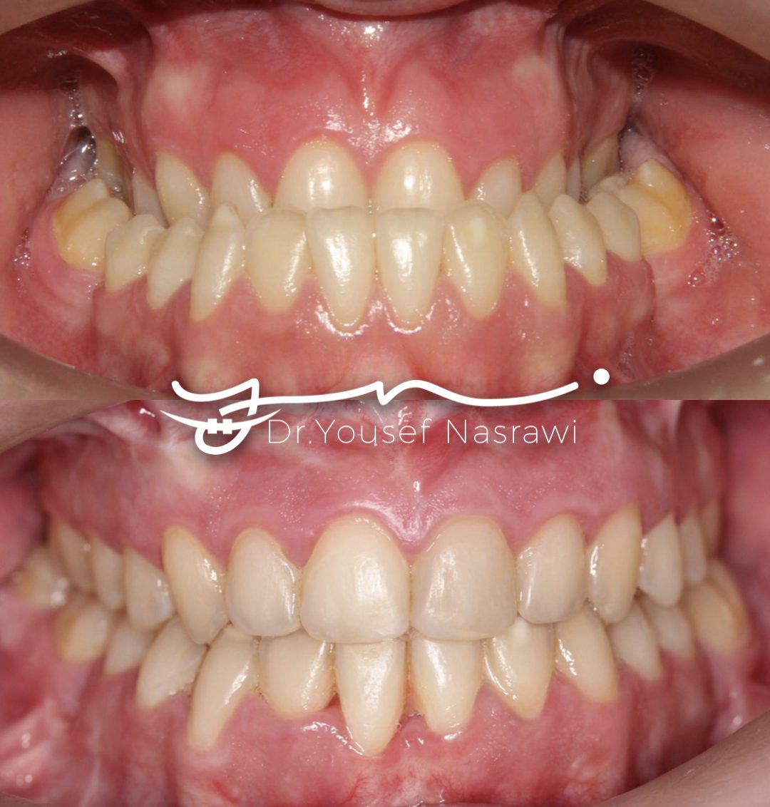 Before and after orthodontic treatment — Class 3, Presurgical orthodontics with orthognathic surgery