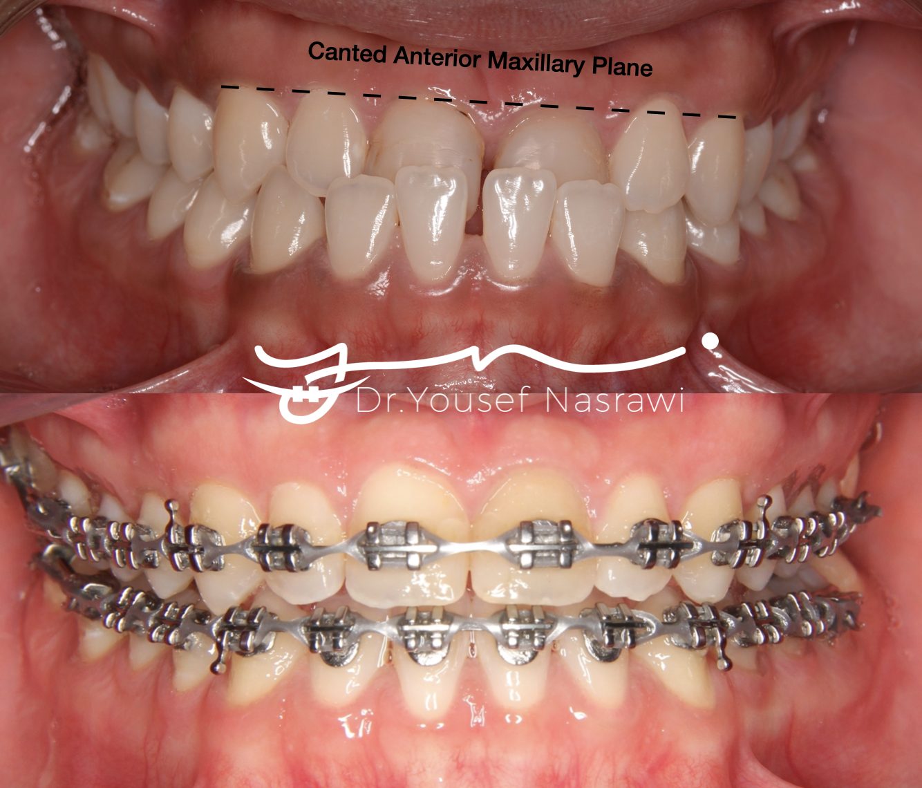 Before and after orthodontic treatment — Class 3 with dental canting, Fixed braces