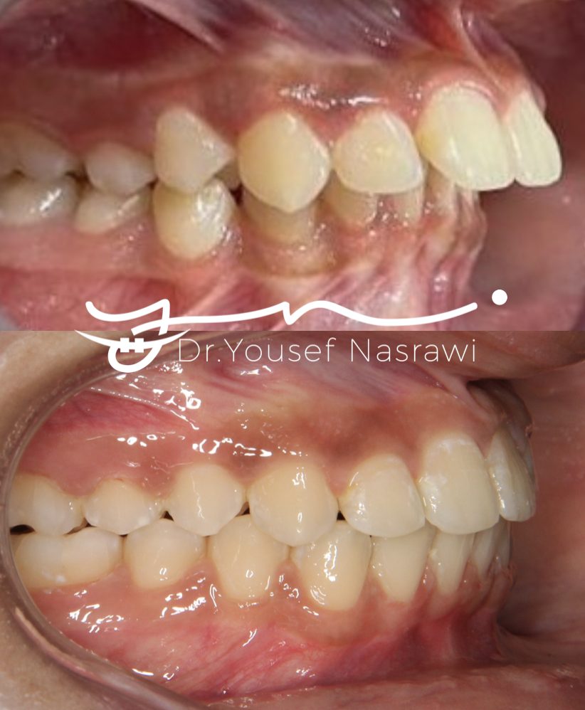 Before and after orthodontic treatment — Class2, Fixed braces
