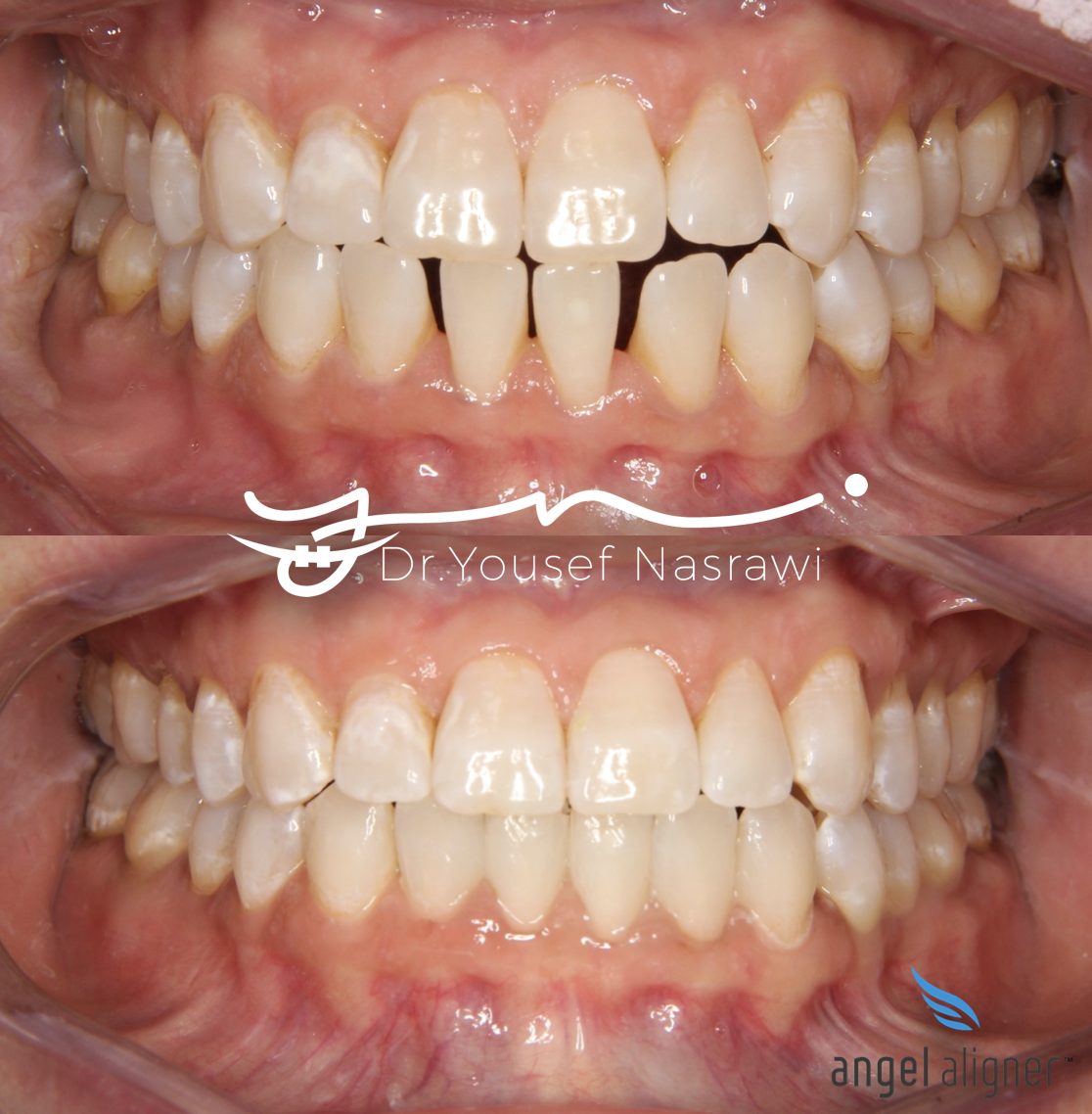 Before and after orthodontic treatment — Clear aligner, Clear aligners