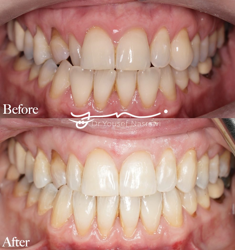 Before and after orthodontic treatment — Clear aligners case with missing upper canine + Retained Primary canine, Clear aligners