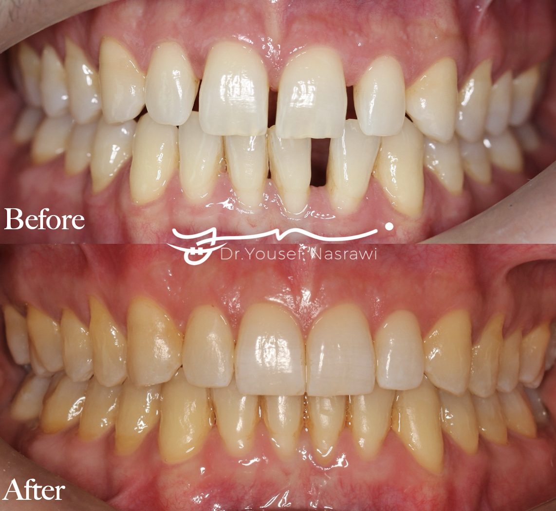 Before and after orthodontic treatment — Clear aligners, Clear aligners