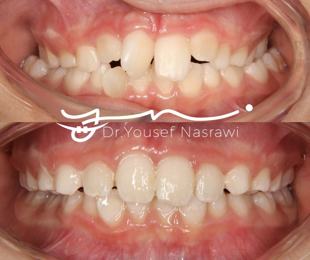 Before and after orthodontic treatment — Expander with upper sectional braces, Palatal expander with upper sectional braces