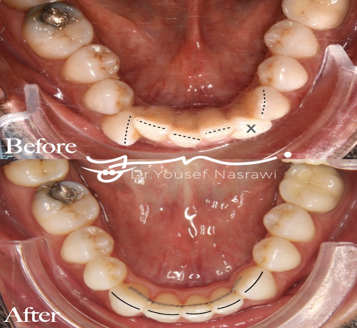 Before and after orthodontic treatment — Extraction of lower incisor case, Fixed braces