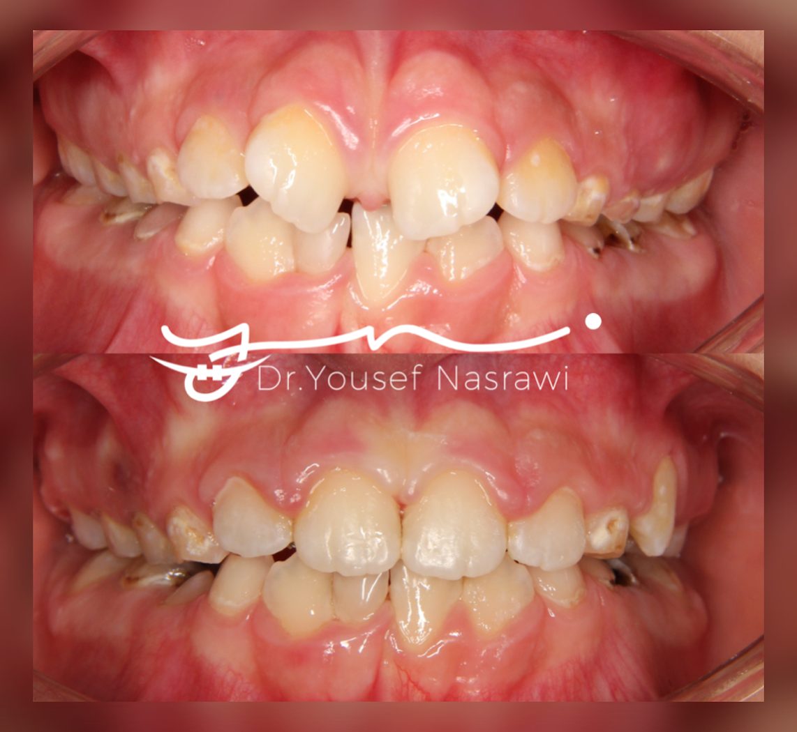 Before and after orthodontic treatment — Headgear + Upper sectional braces (2x4 appliance), Headgear with upper sectional braces (2x4 appliance)