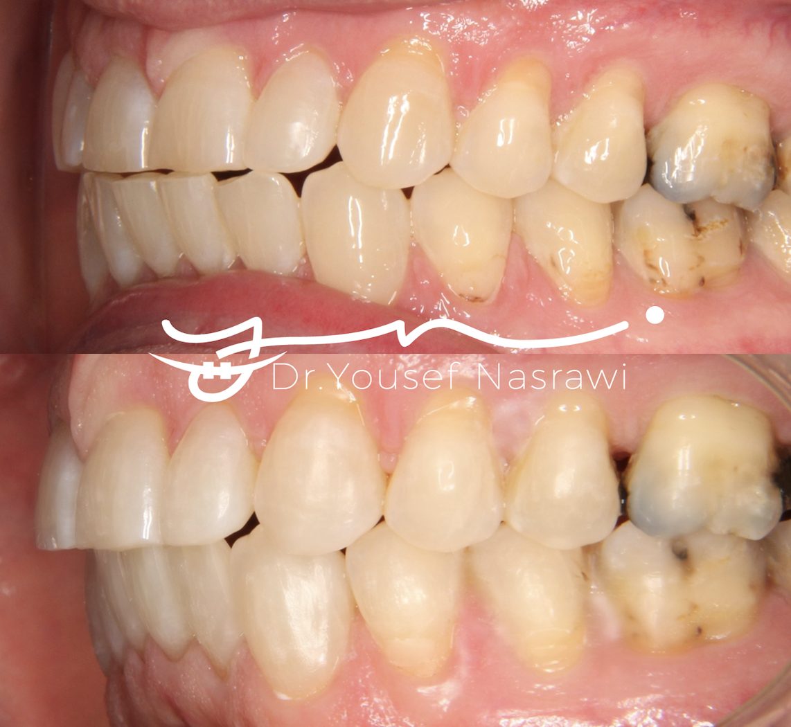 Before and after orthodontic treatment — Lower clear aligner, Clear aligners