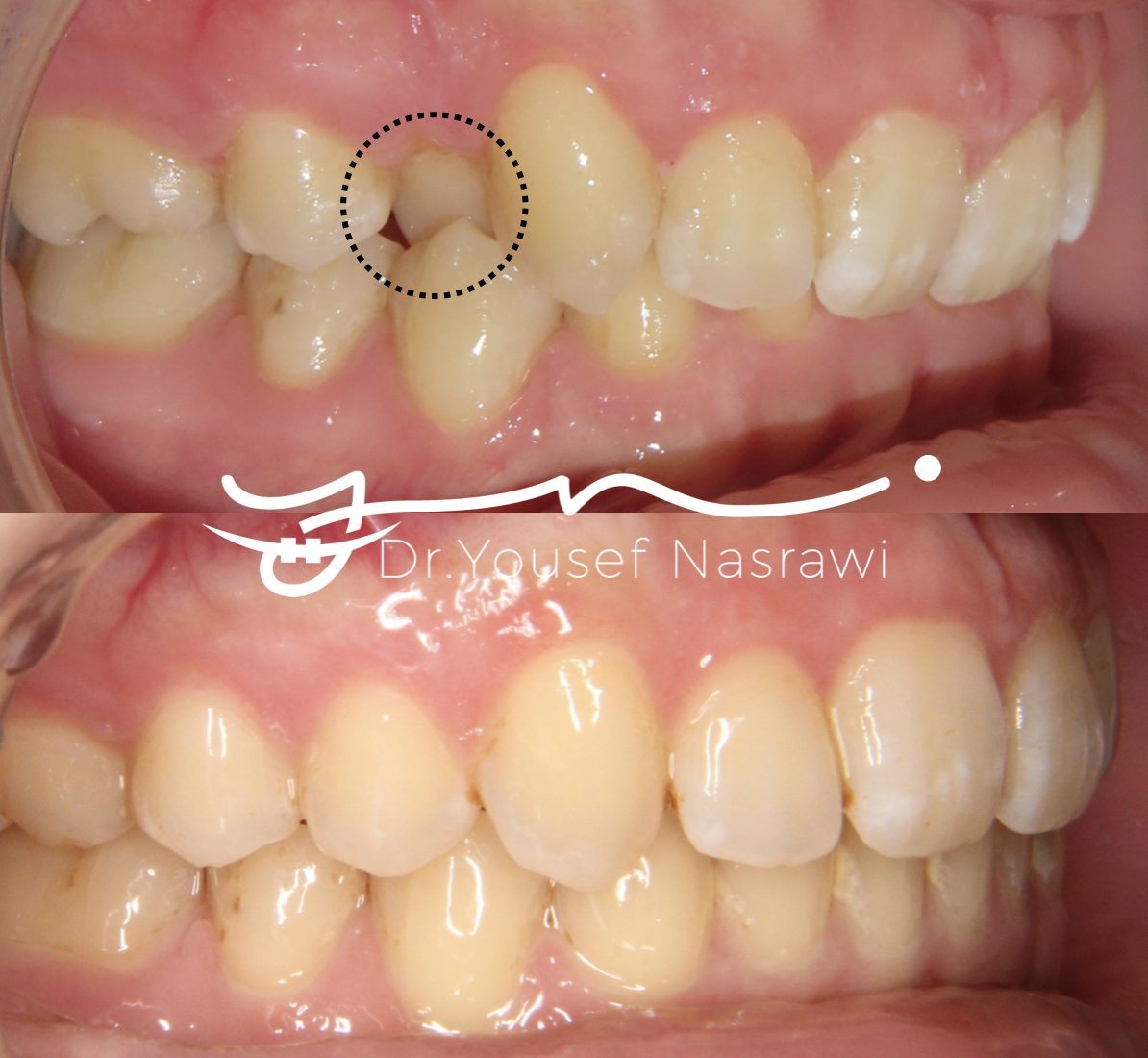 Before and after orthodontic treatment — Posterior cross bite, Fixed braces
