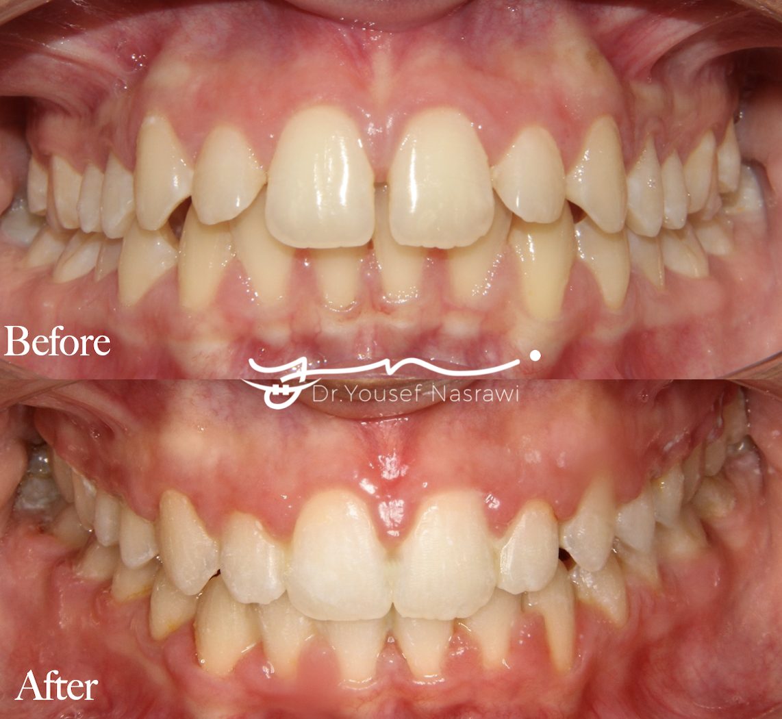 Before and after orthodontic treatment — Spacing + Deep bite, Fixed braces