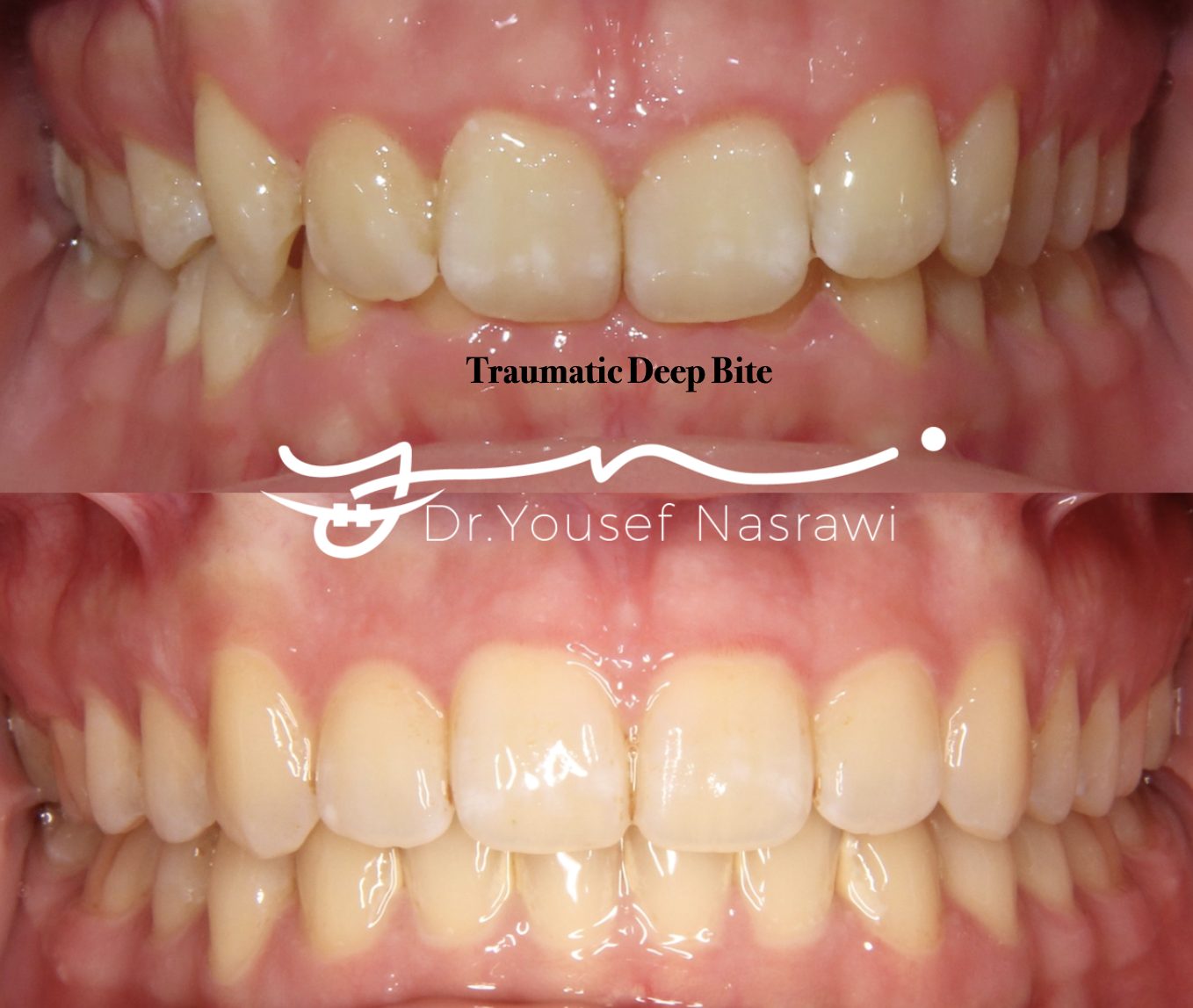 Before and after orthodontic treatment — Traumatic Deep bite, Fixed braces