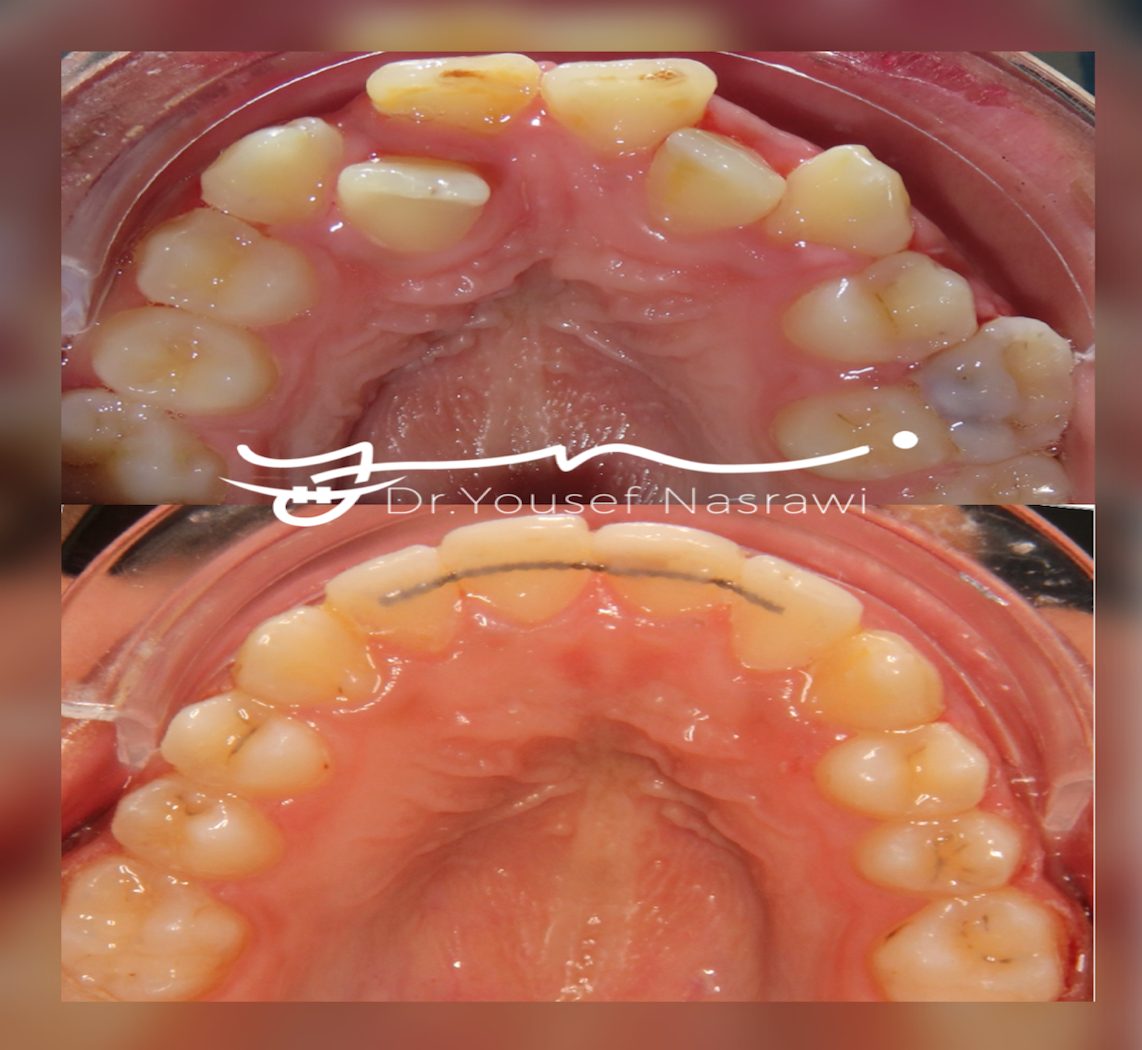 Before and after orthodontic treatment — Tucked in laterals, Fixed braces