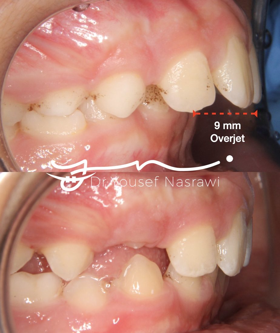 Before and after orthodontic treatment — Twin block, Twin block functional appliance with fixed braces
